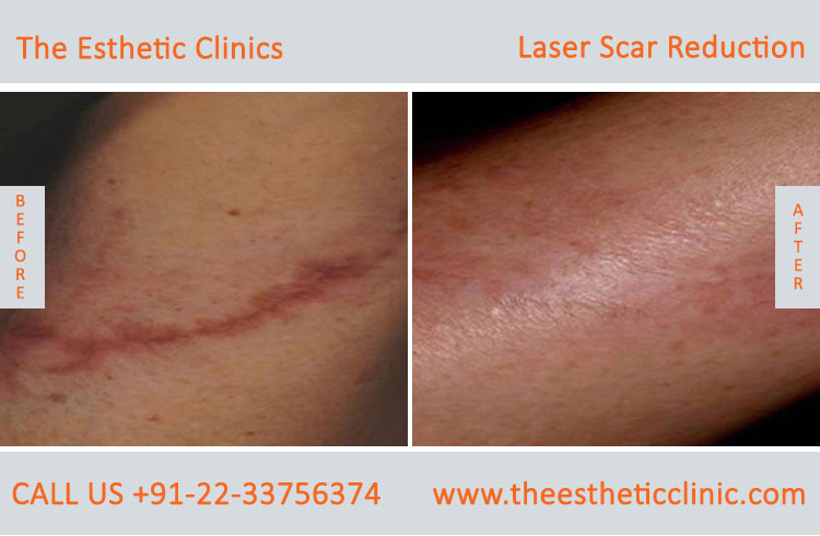 Laser scar reduction removal Treatment before after photos in mumbai india (2)